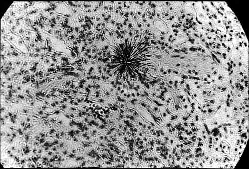 hot-particle-lung-tissue1997