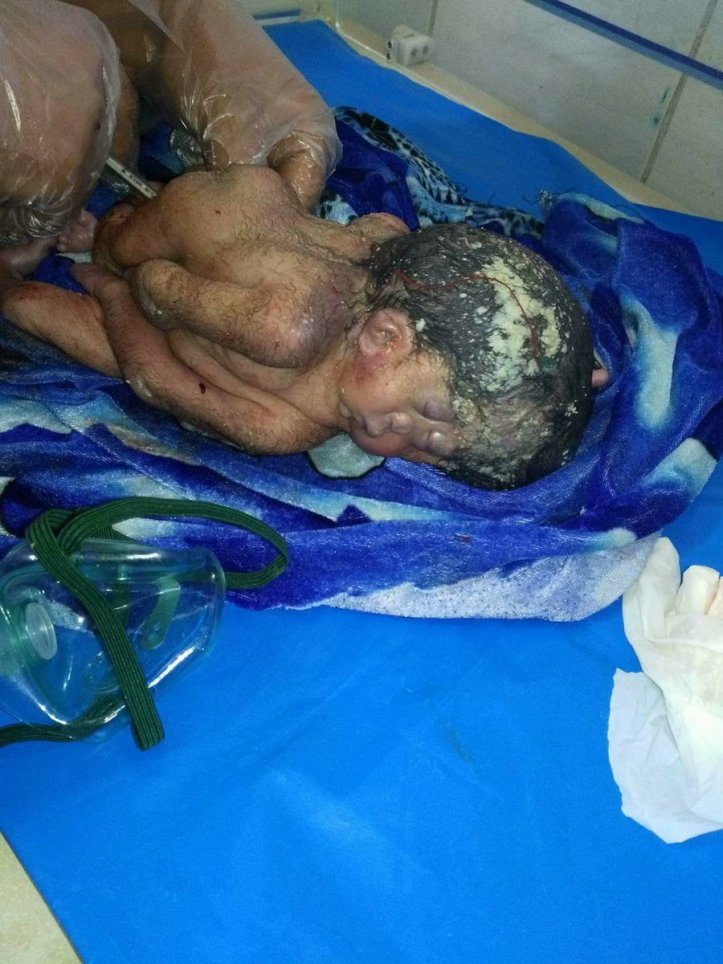 Al Anbar Al qa'im general hospital may 2018 joined siblings