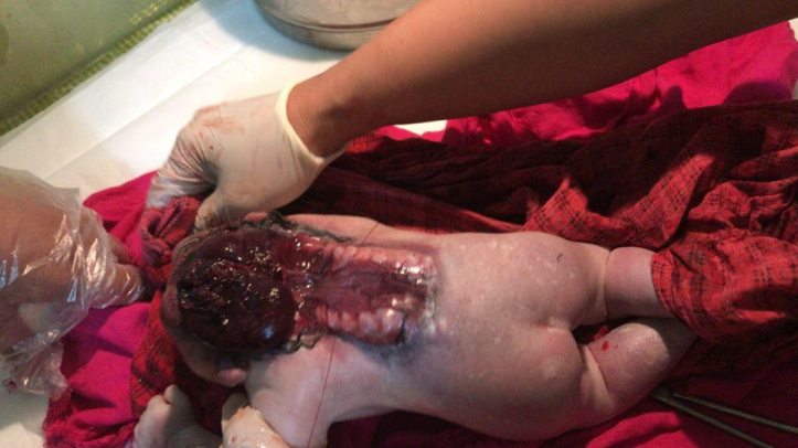 anencéphalie 20 avril 18 FJH