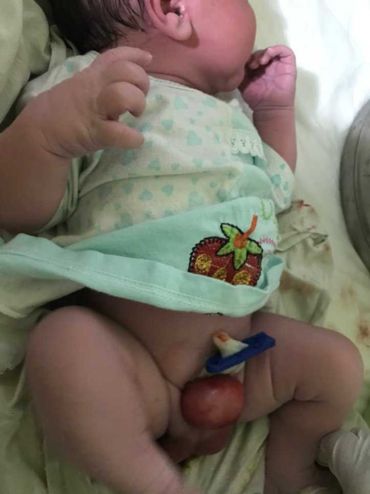 Bladder outside 17 april 18 Fjh