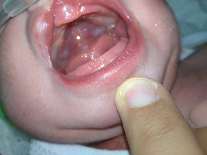 cleft lip 22 april 18 fjh