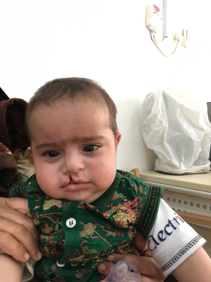 cleft palate 2 april 18 fjh