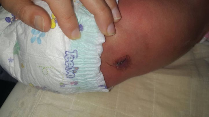 spina bidifa 08 april 2018 FJH