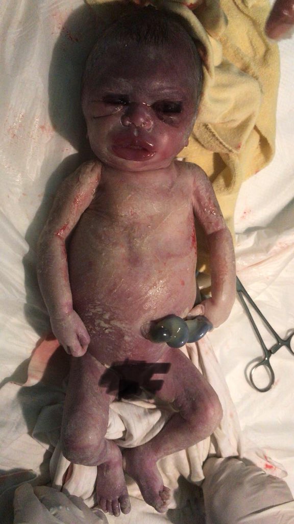 stillbirth fetal hydrops end of april 18 FJH